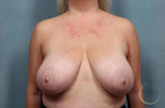 Breast Reduction Case 26 Before